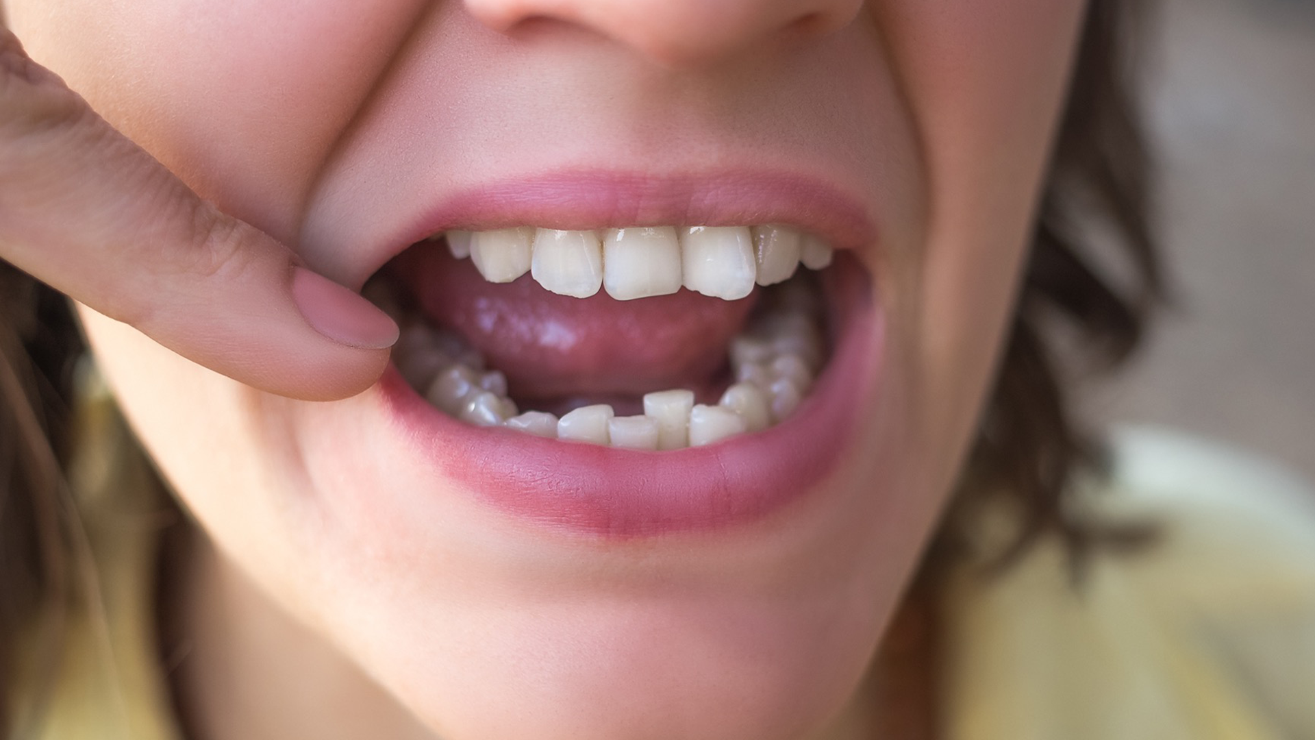 Crowded Teeth or Protruding Front Teeth? How the Inman Aligner Can Help Quickly