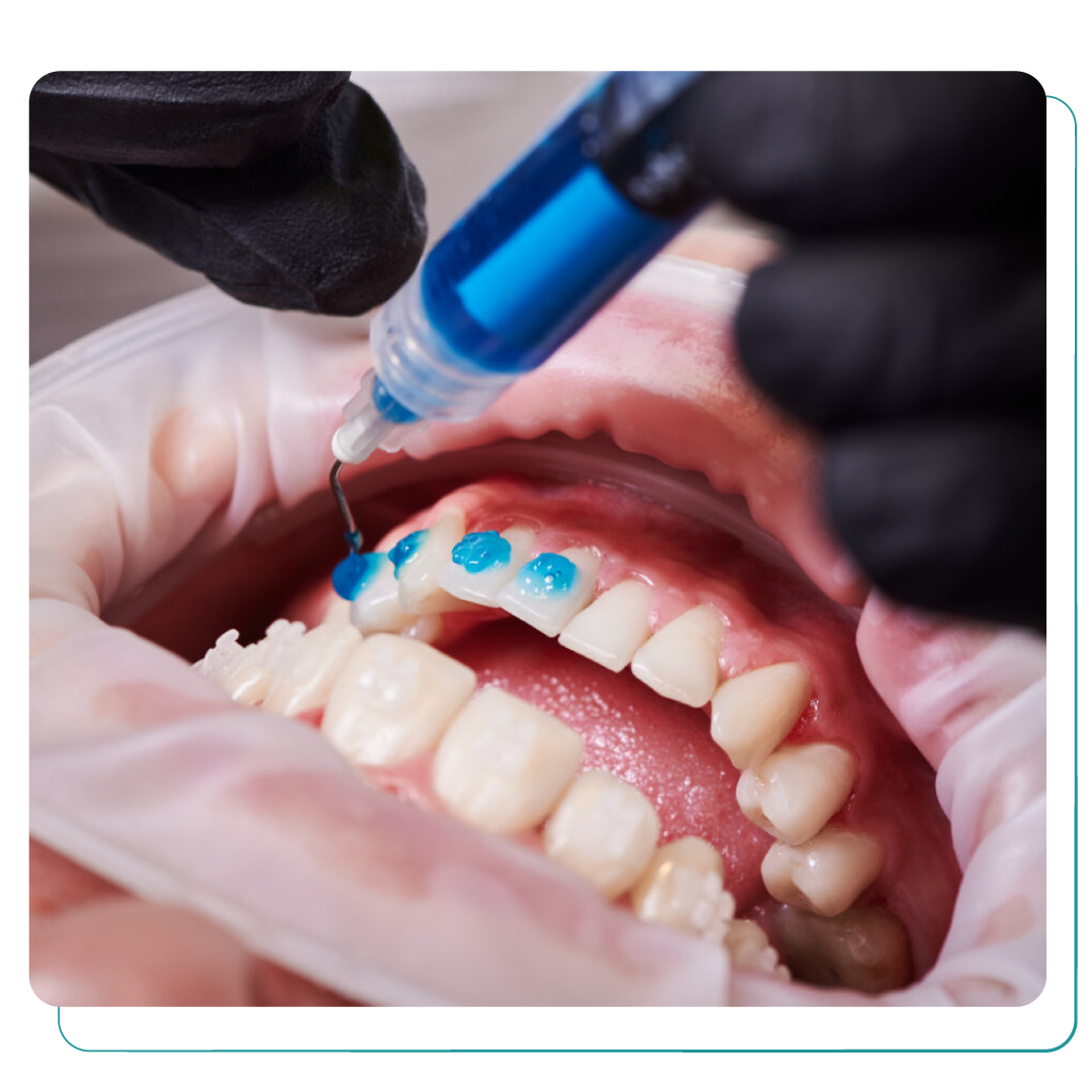 Fluoride Treatment