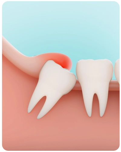 Wisdom Tooth Removal in Canberra