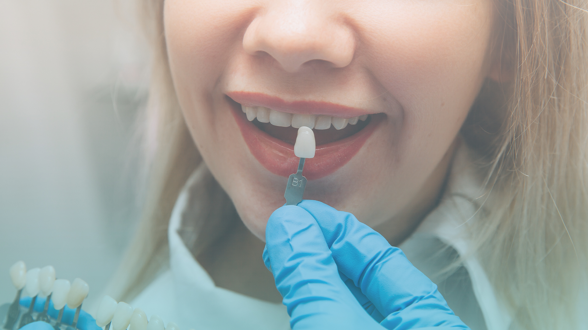 Composite Bonding Treatment Canberra