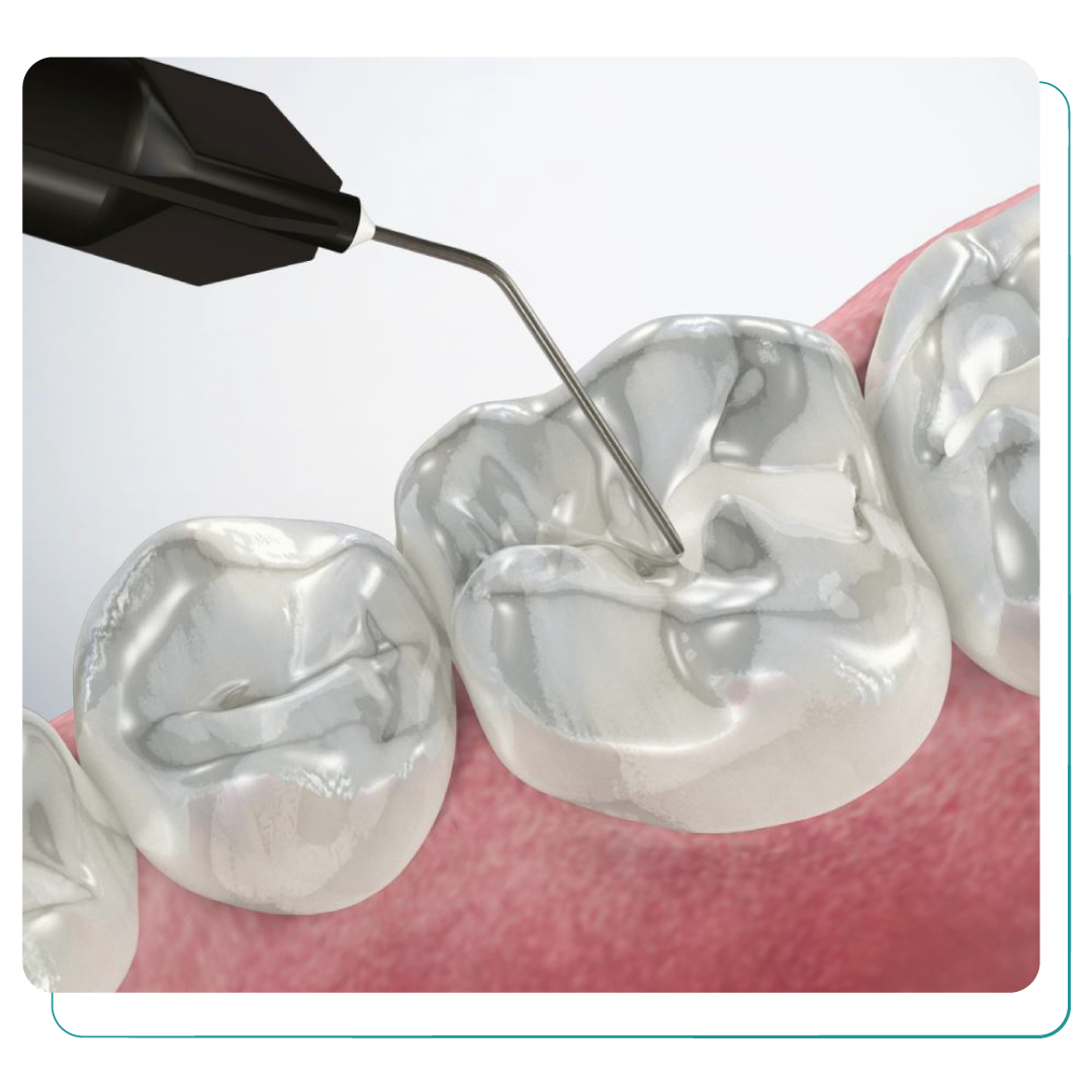 Fissure Sealants
