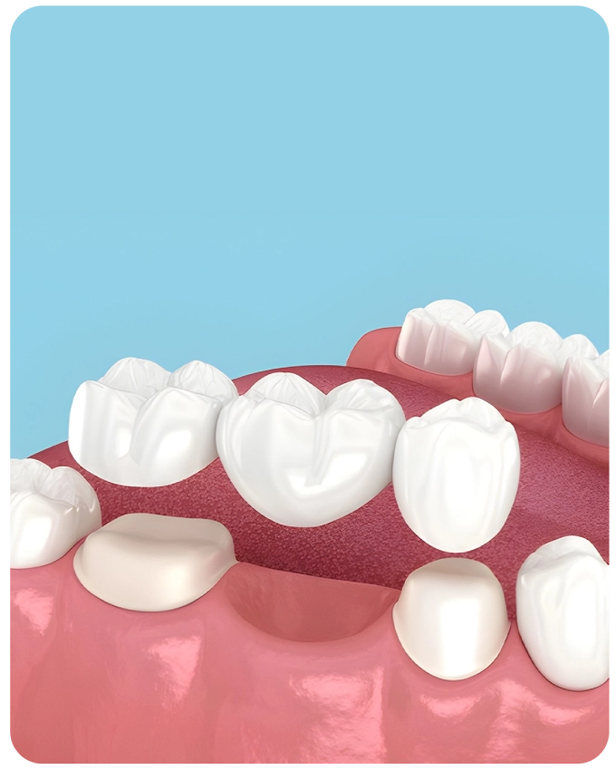 Dental Bridge Canberra