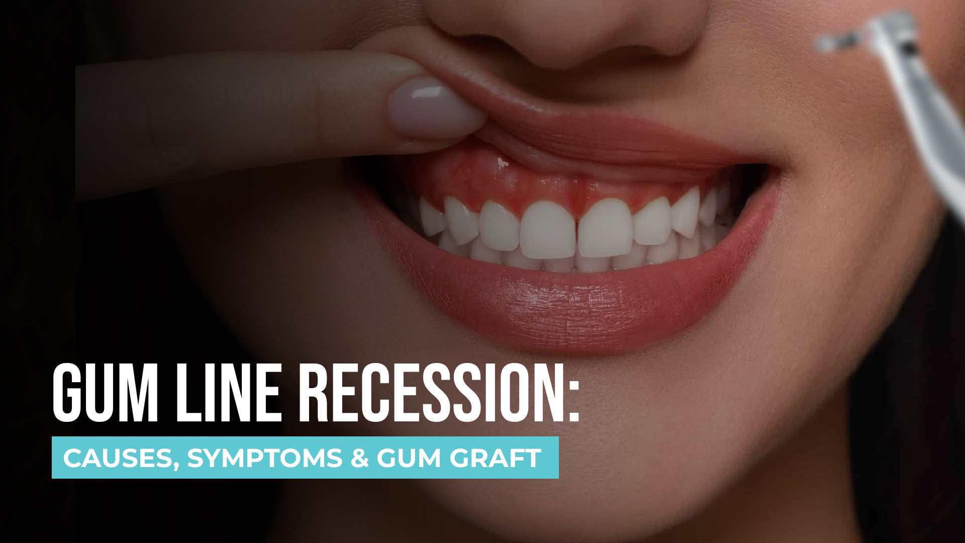 Gum Line Recession: Causes, Symptoms & Gum Graft