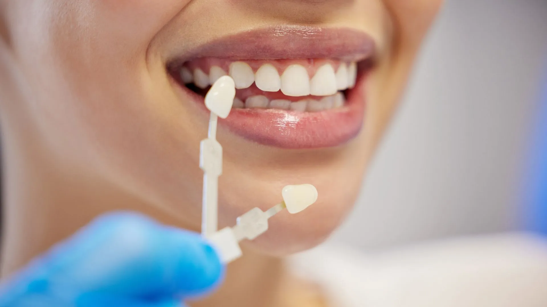 How much do veneers cost in Canberra?