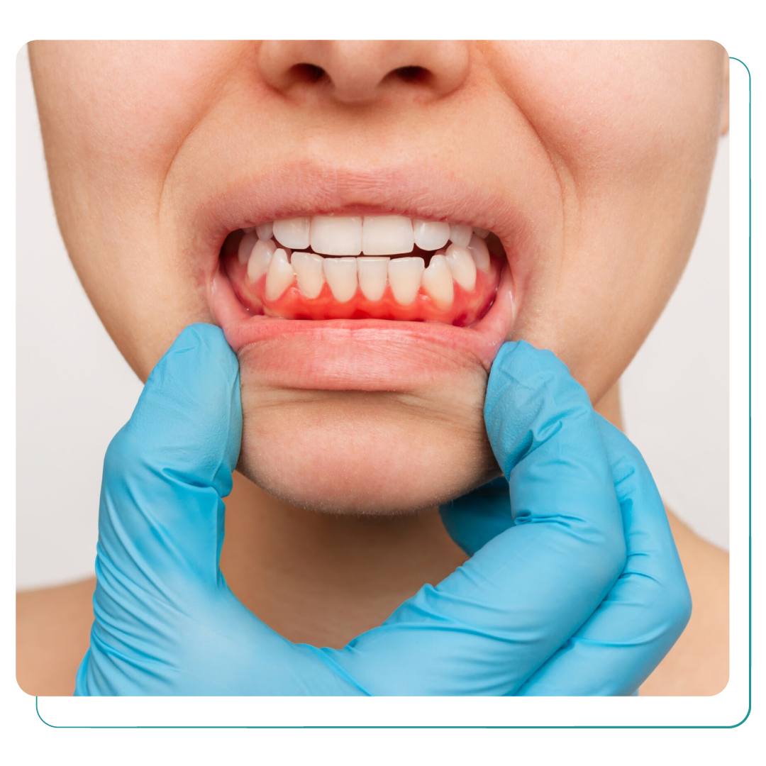 Gum Disease Treatment