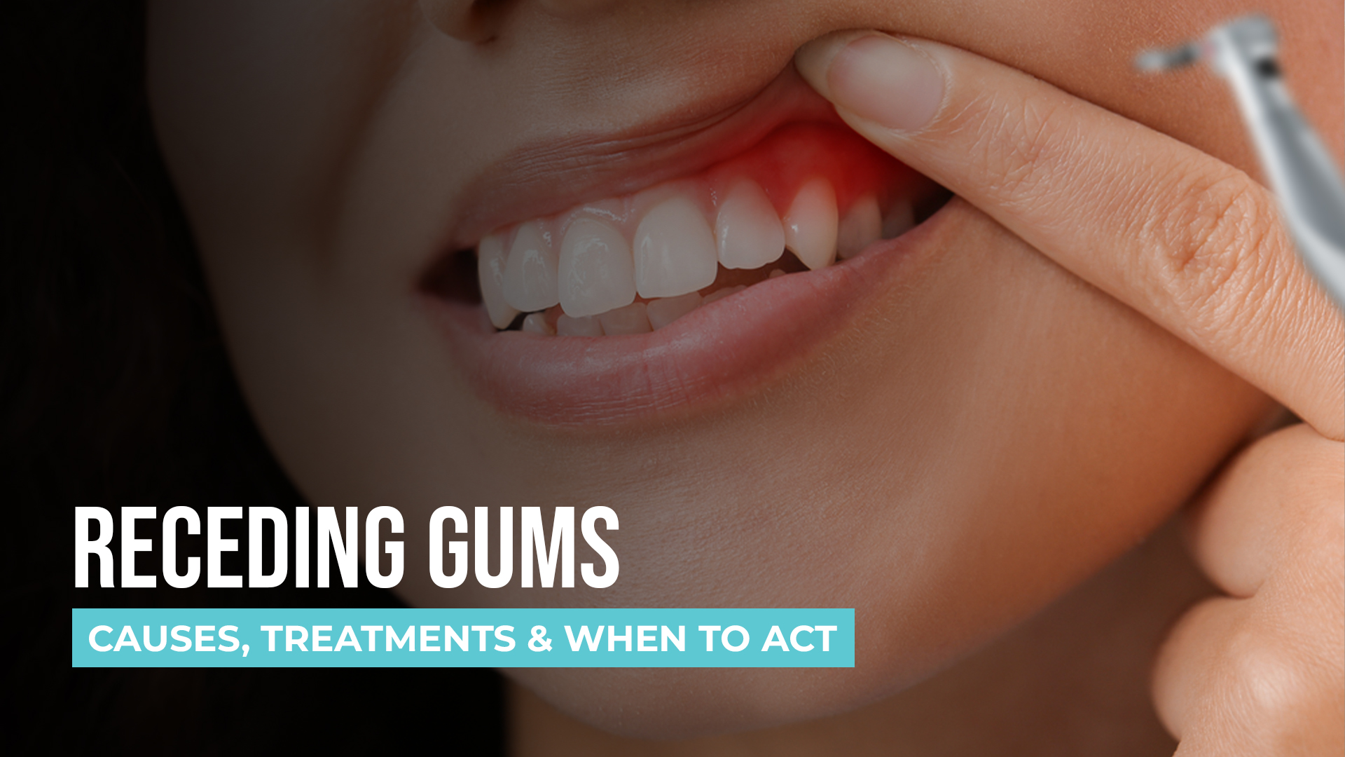 Receding Gums: Causes, Treatments & When to Act