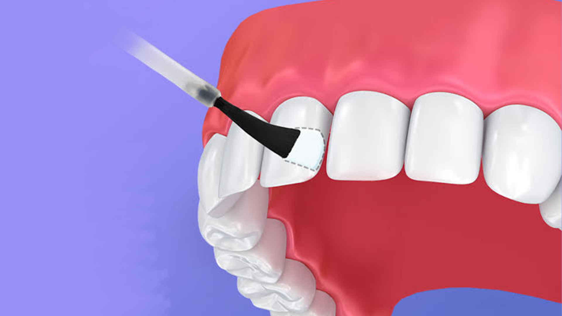 Understanding the Role of Fluoride in Dental Health