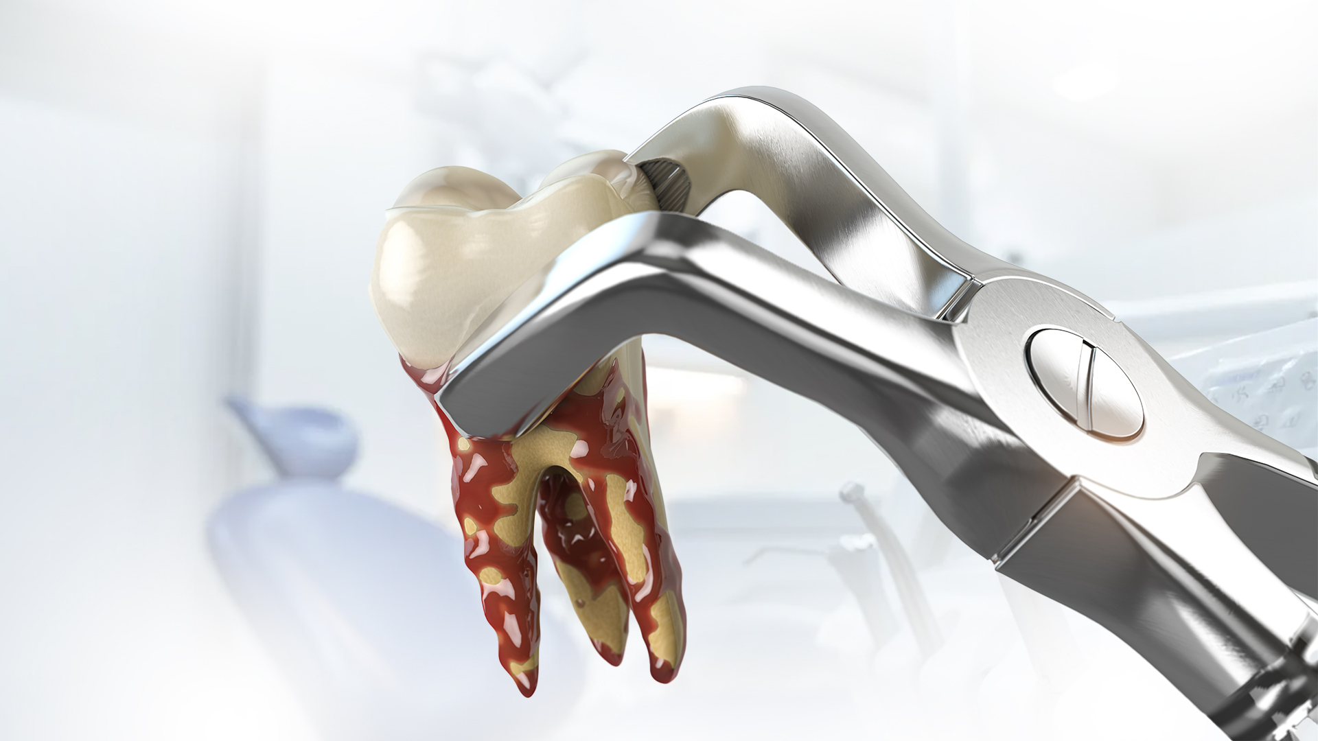 Tooth Removals & Extraction Canberra