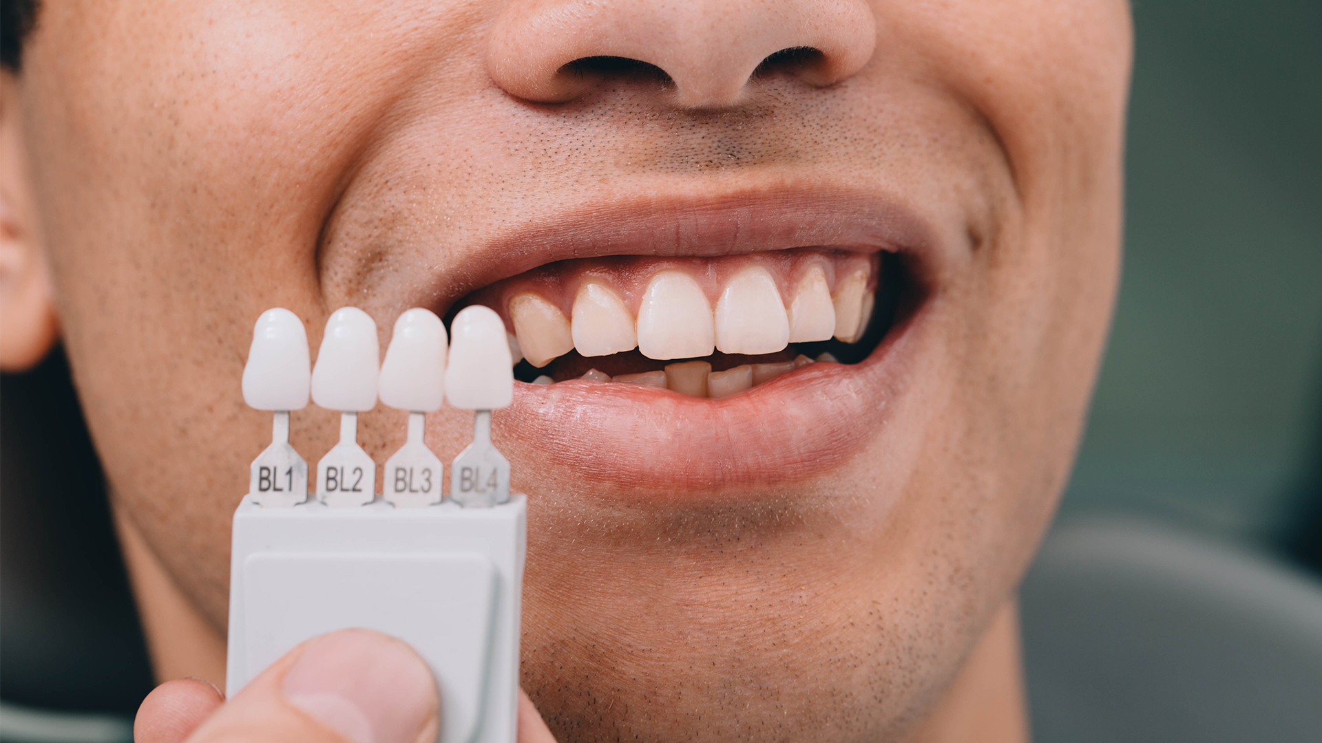Porcelain Veneers Canberra