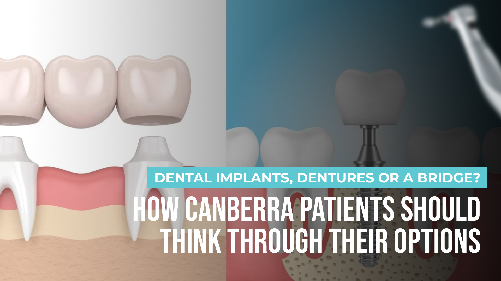 Dental Implants, Dentures or a Bridge? How Canberra Patients Should Think Through Their Options