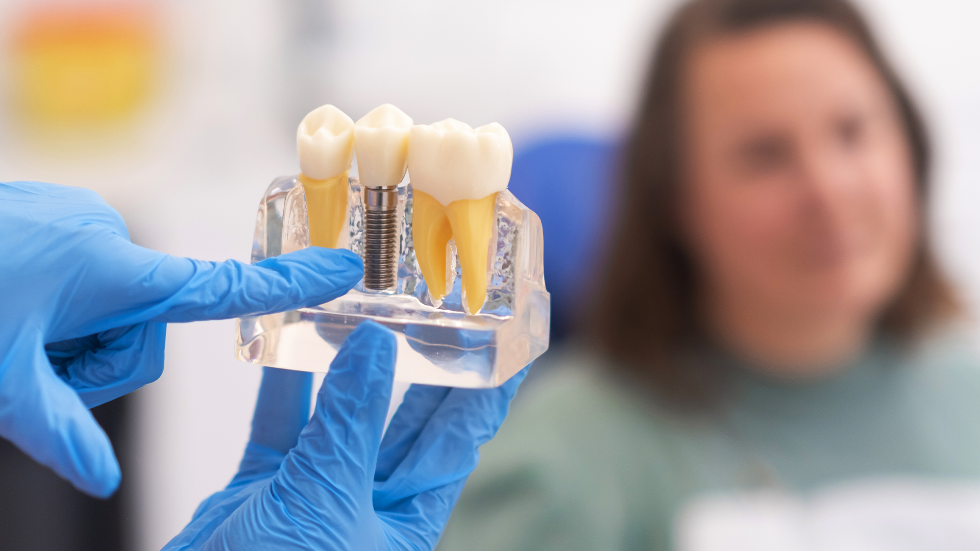 Dental Implants Canberra: The Complete Patient Guide