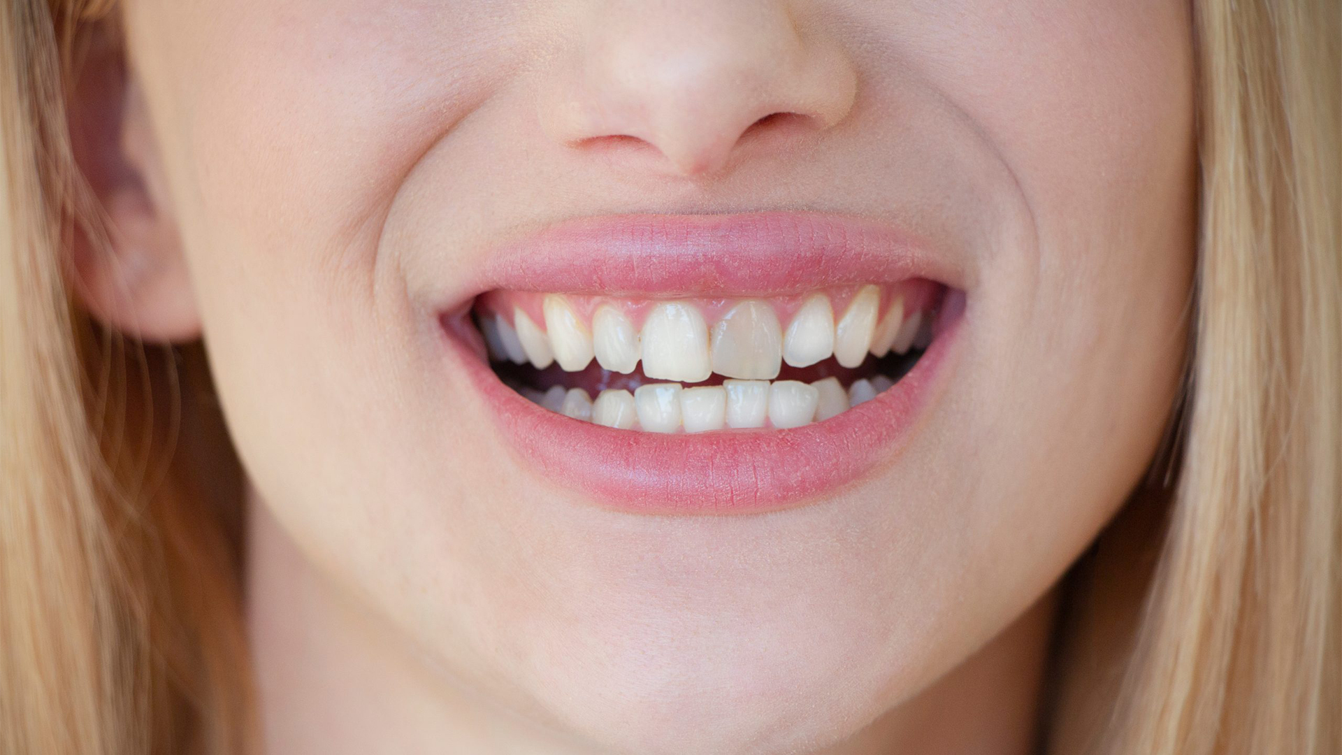Discoloured Teeth: Causes, Treatments and How to Whiten Them