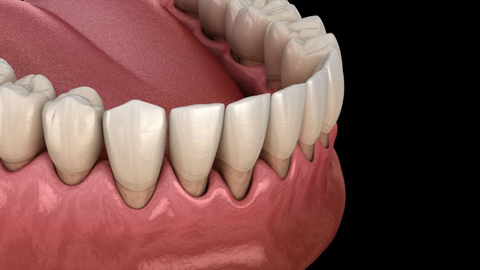 Gingival Recession Causes