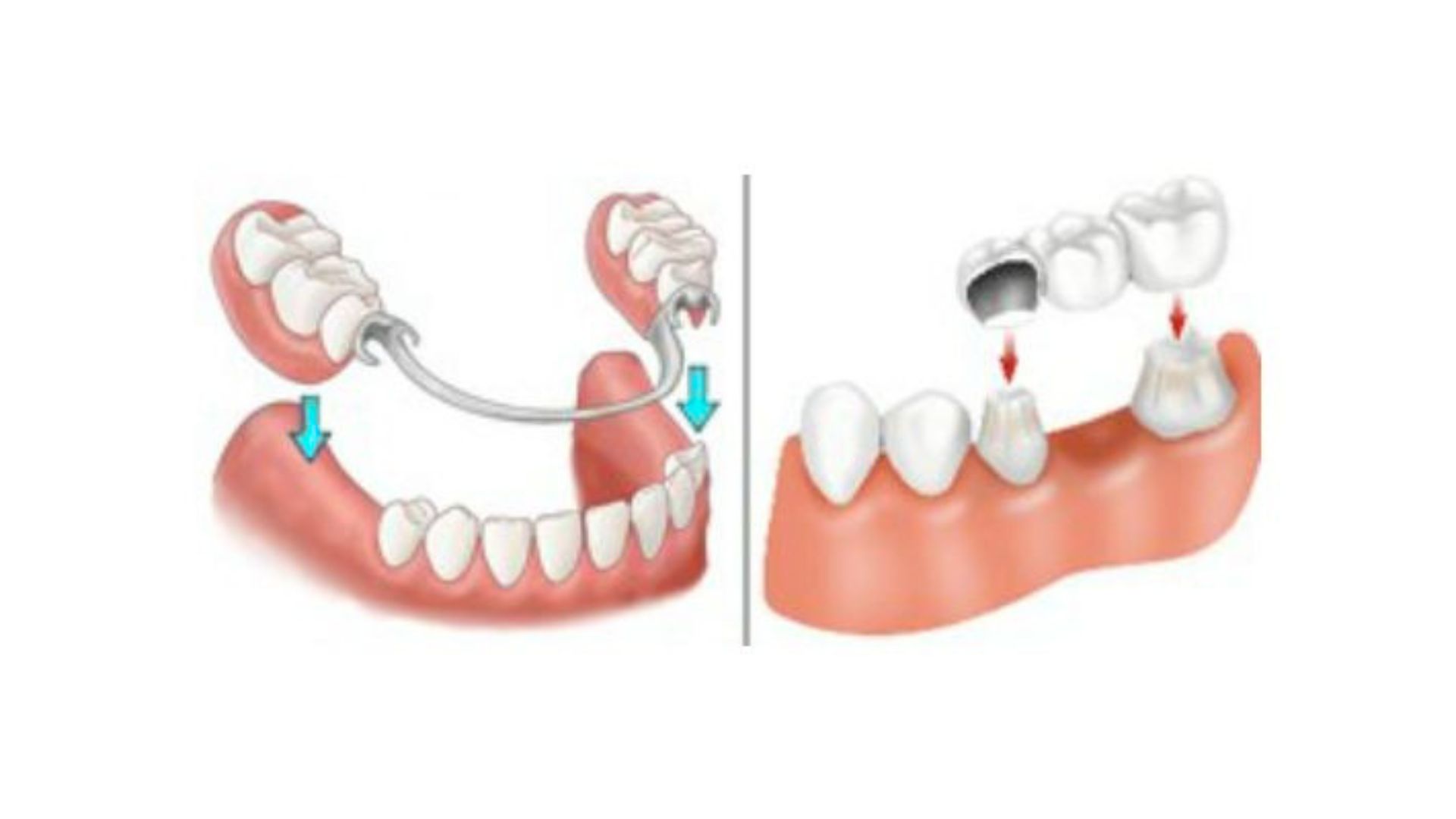Dental Bridge vs Partial Denture