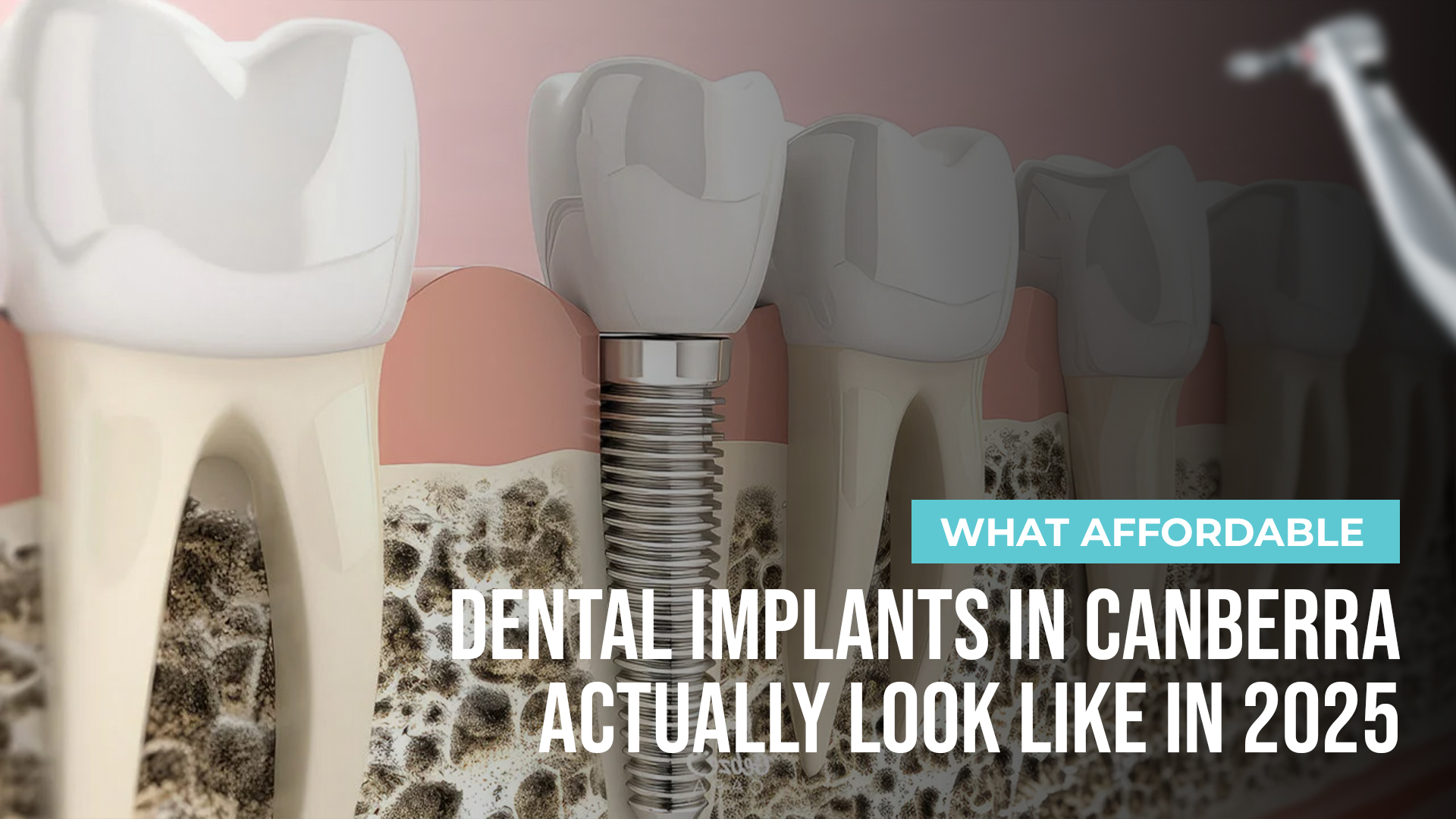 What Affordable Dental Implants in Canberra Actually Look Like in 2025