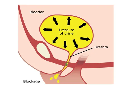 Pressure of urine in overflow incontinence