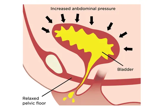 Increased abdominal pressure for the bladder