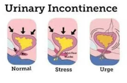 Types of menopausal urinary incontinence (stress, normal and urge)