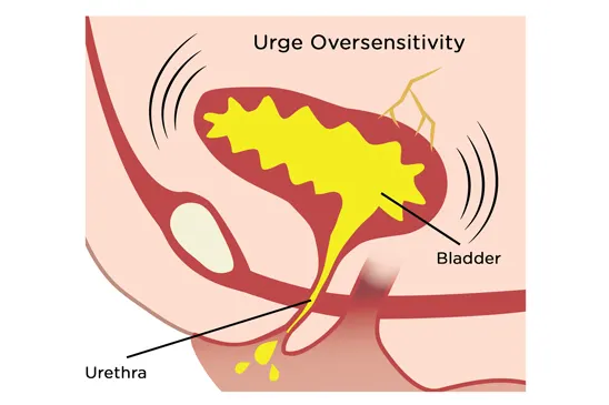 Urge oversensitivity