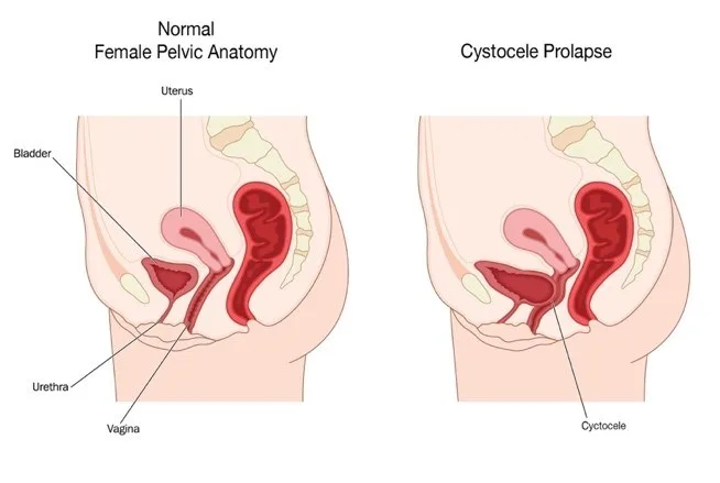 Normal female pelvic anatomy vs cystocele prolapse