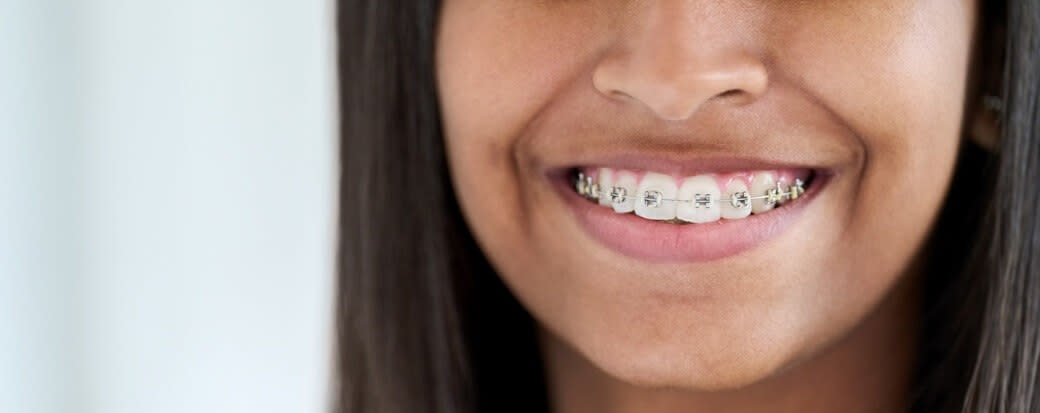 The Cost of Braces & Your Financing Options