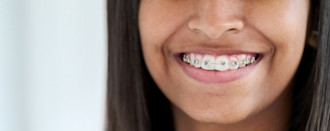 How Much Do Braces Cost?