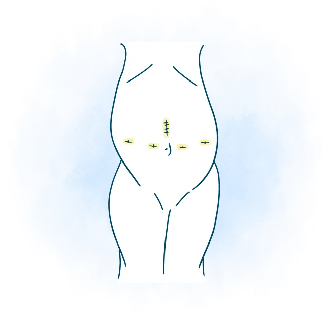 media-body-stitches-robotic-transplant-surgery-works-m