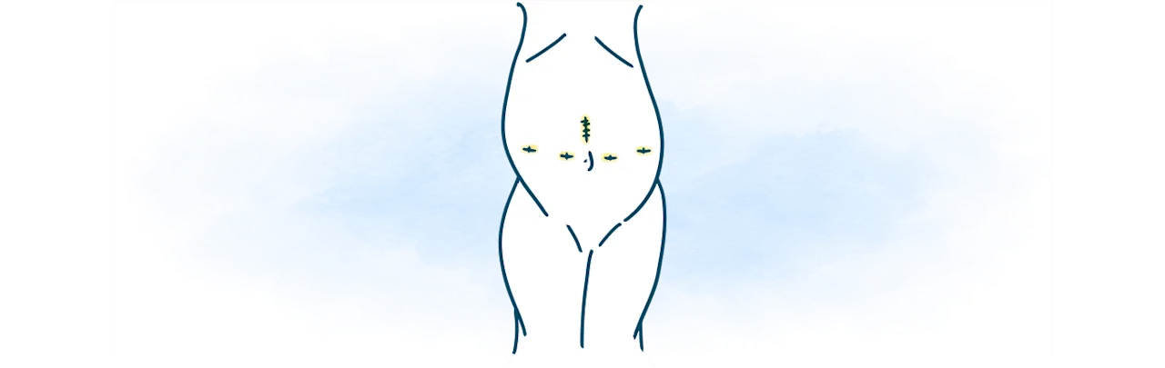 media-body-stitches-robotic-transplant-surgery-works-d