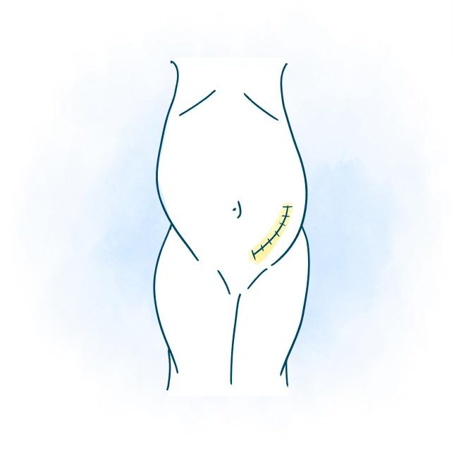 media-body-stitches-open-surgery-transplant-surgery-works-m