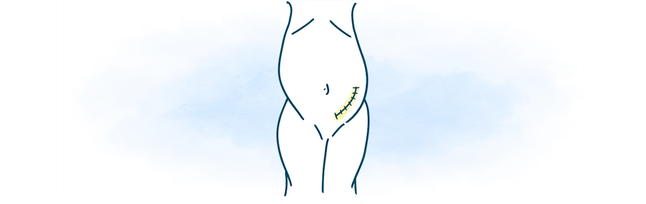 media-body-stitches-open-surgery-transplant-surgery-works-d