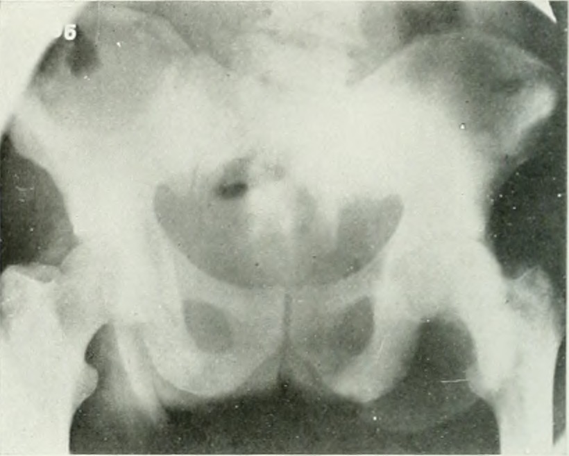 An X-ray of the pelvis in a patient with prostate cancer. Source: University of Toronto. 