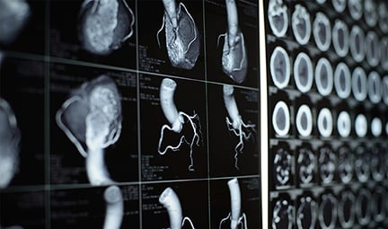 Heart CT scan