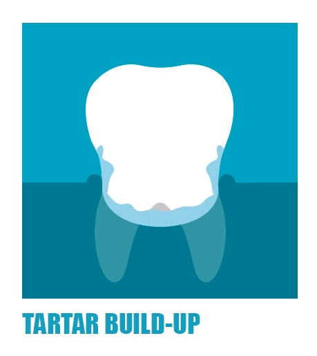 symptoms-of-gum-problems-tartar-build-up