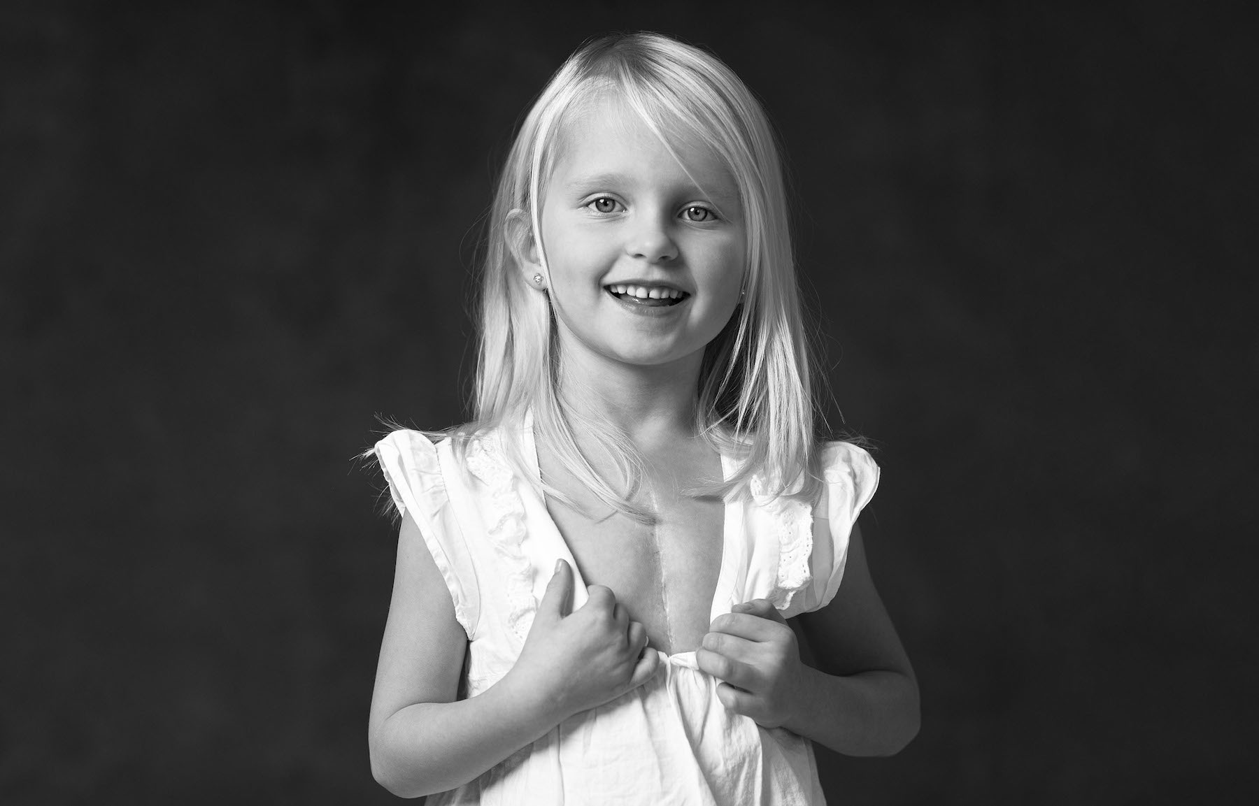 Flicka som visar sitt ärr efter hjärtoperation