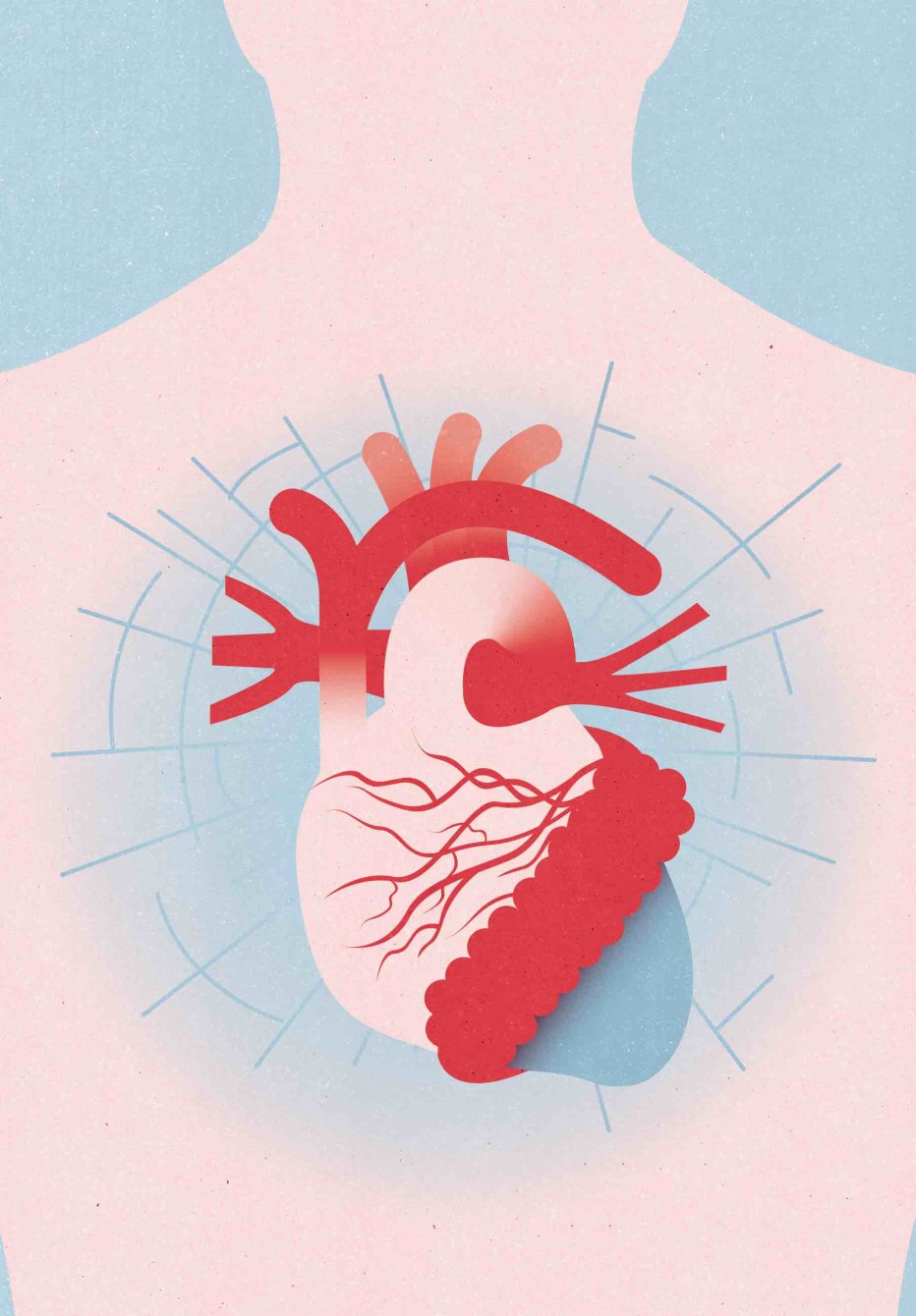 Illustration som visar hjärtinfarkt.