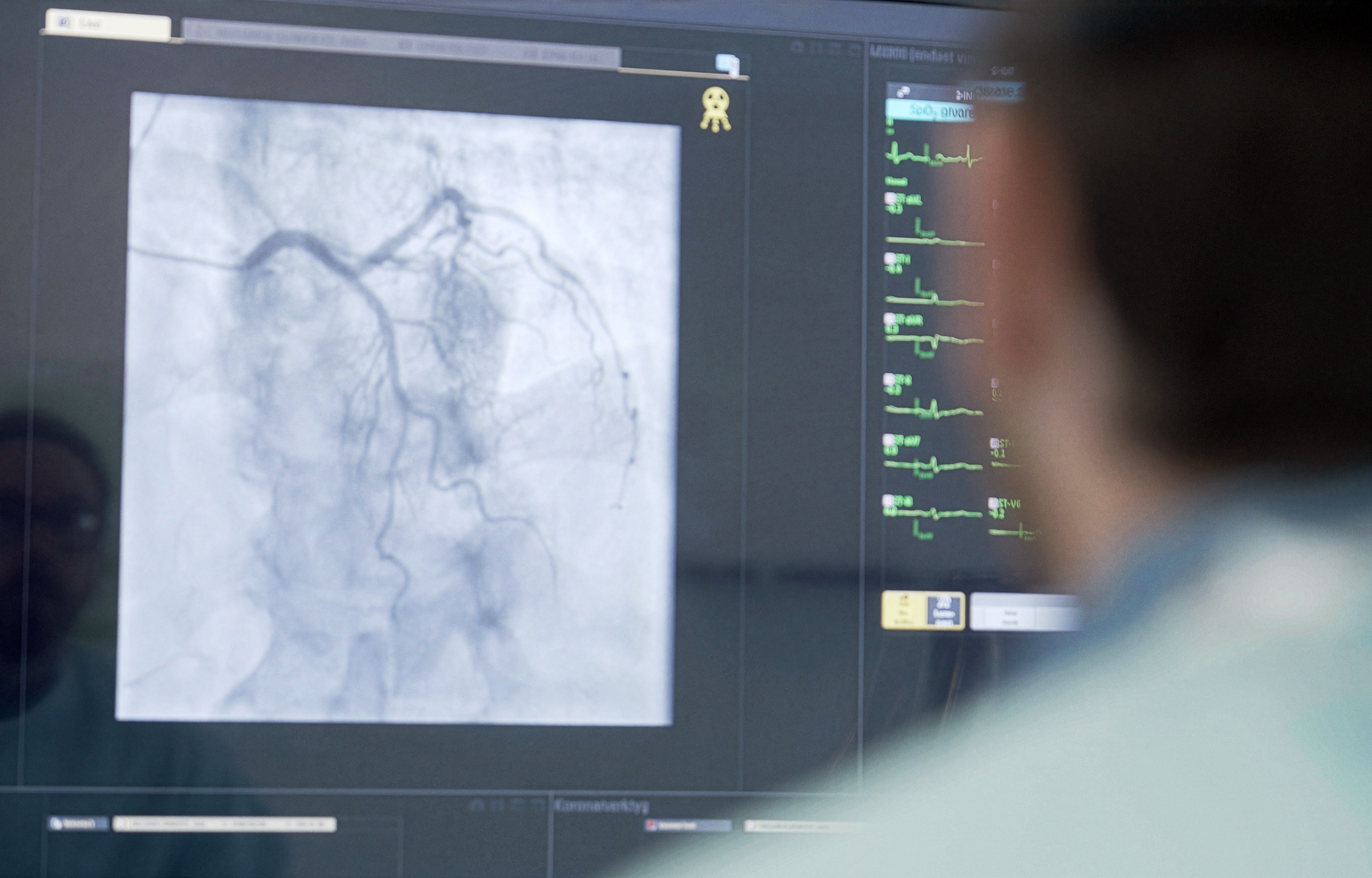 Läkare tittar på hjärtröntgen på dator