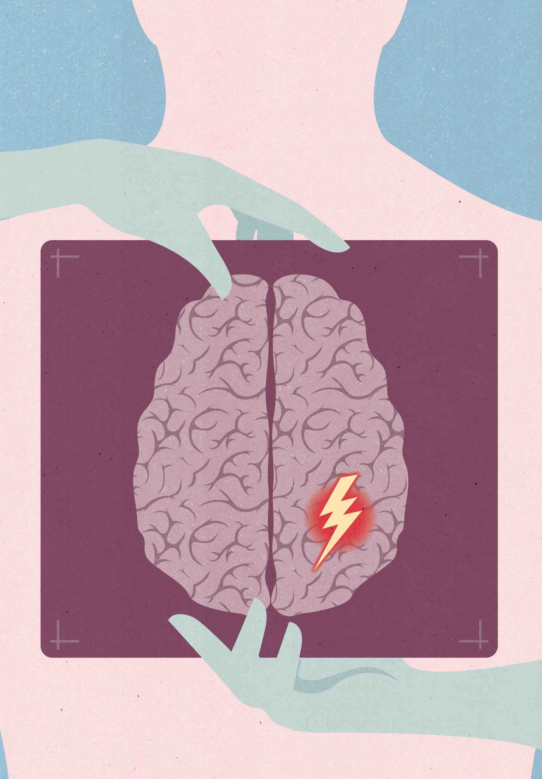 Illustration som visar stroke.