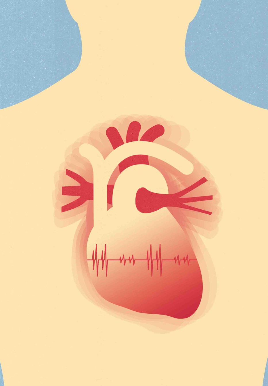 Illustration som visar hjärtrytmrubbningar.