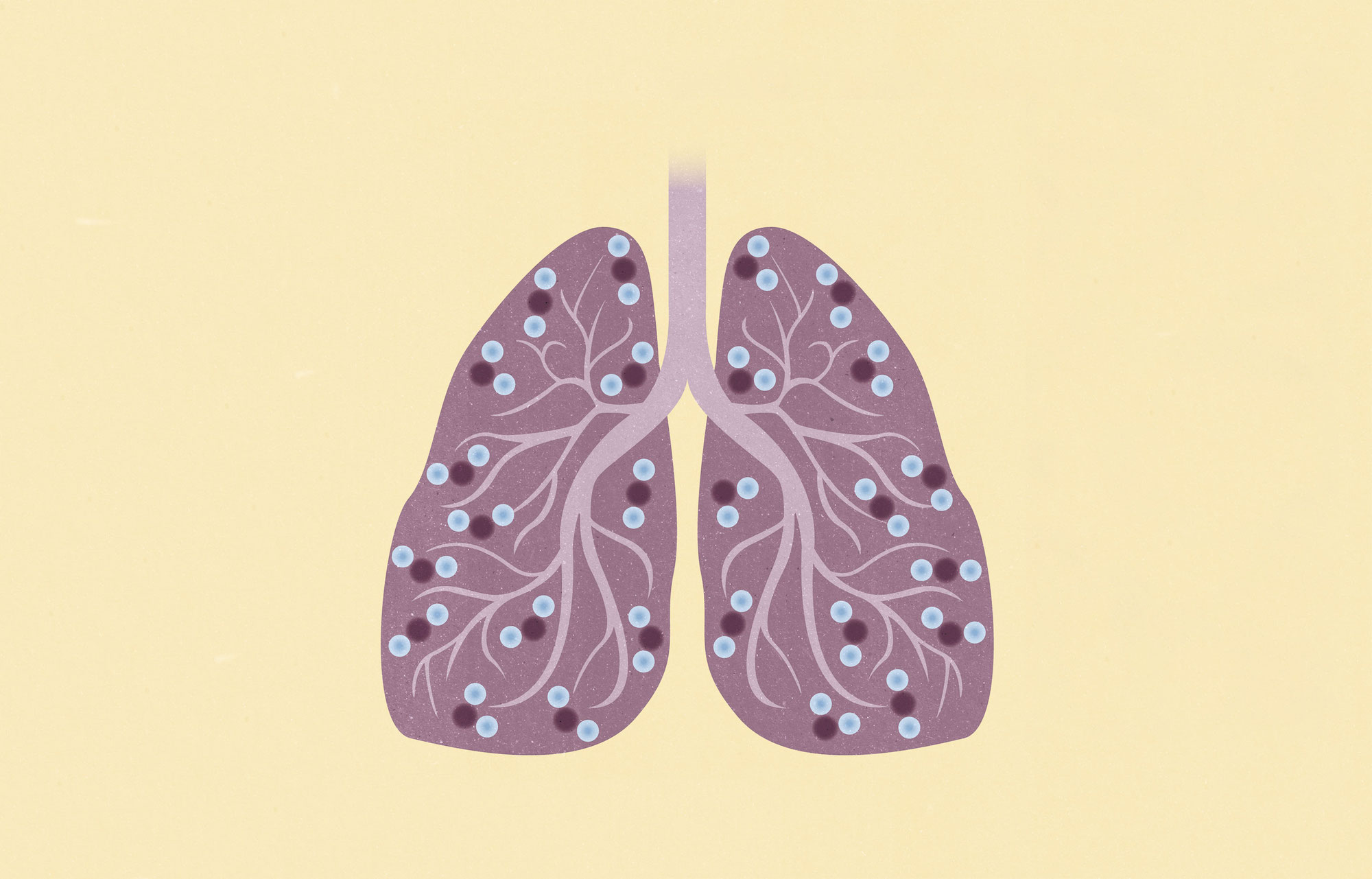 Illustration som symboliserar lungsjukdomen KOL