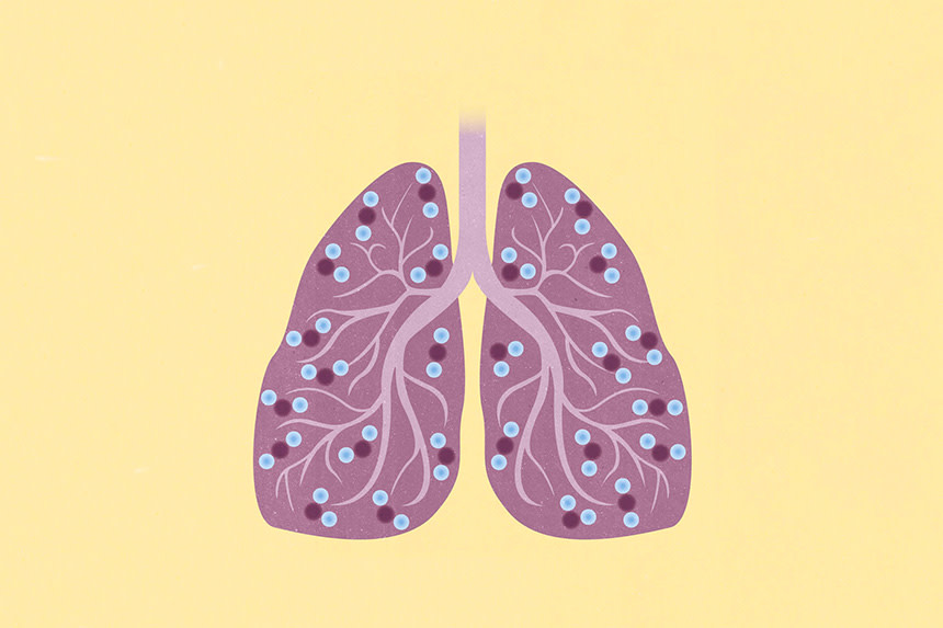 Illustration av lungor som drabbats av KOL