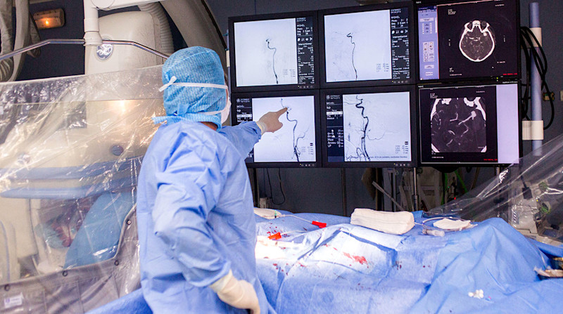 En trombektomi och samtidig angiografi av hjärnan utförs på en patient med stroke.