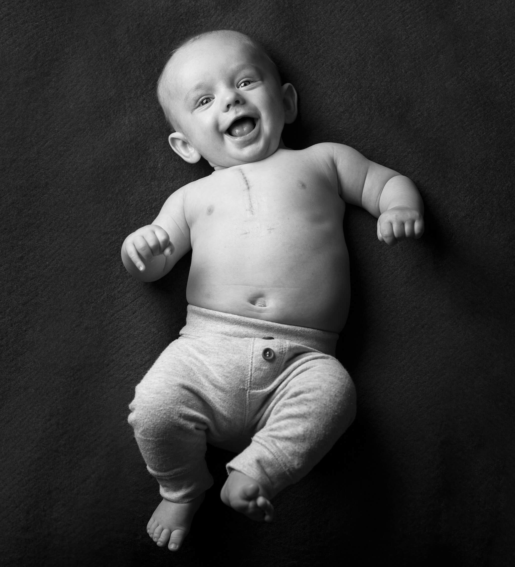Bebis i sparkbyxor med ärr på bröstet