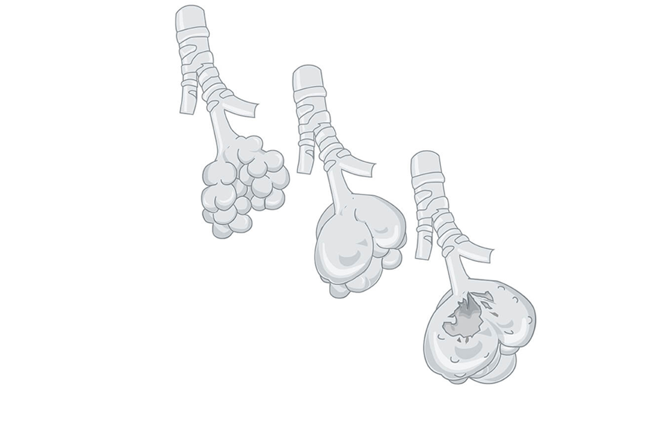 KOL, en illustration av emfysem