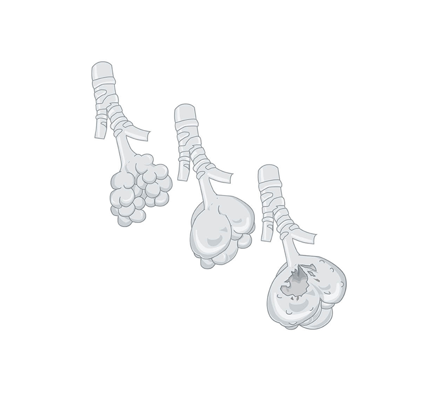 KOL, en illustration av emfysem