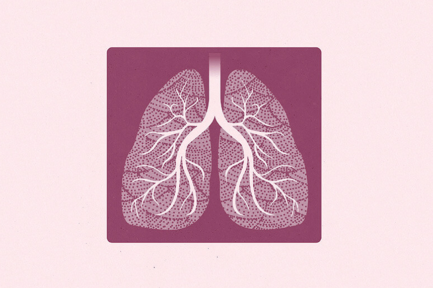 Lungfibros – Symtom och riskfaktorer