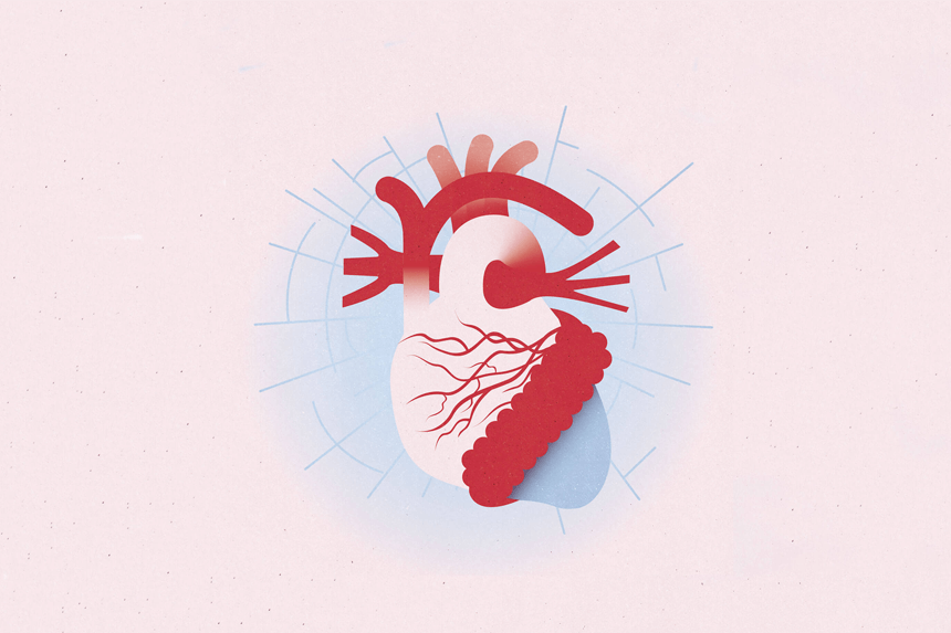 Illustration hjärtinfarkt