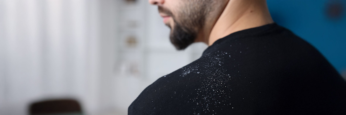 Ein bärtiger Mann in einem dunklen Pullover mit sichtbaren weißen Flocken auf der Schulter.