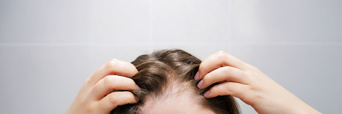 Eine Nahaufnahme eines gescheitelten Kopfhaars, die deutlich weiße Schuppen zwischen den Haarsträhnen zeigt.