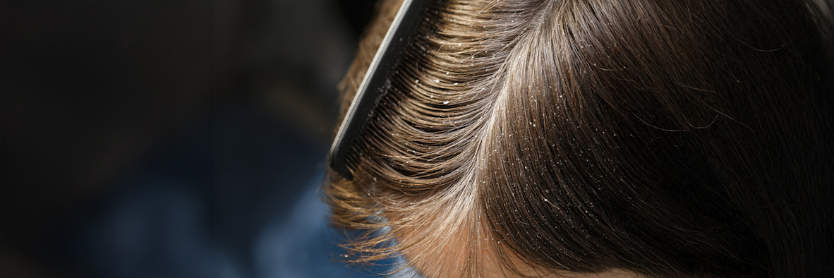 Extreme Nahaufnahme von dunklen Haarsträhnen, die die Kopfhautoberfläche detailliert zeigen.