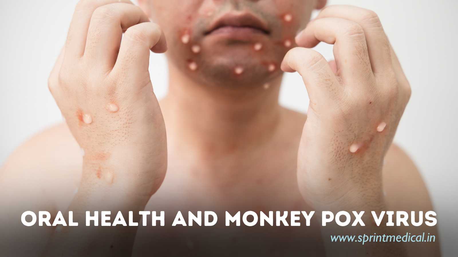 Oral Health and Monkey Pox Virus